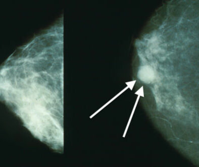breast_cancer_mammo