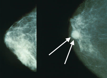breast_cancer_mammo breast_cancer_mammo